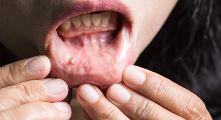 Cáncer Oral