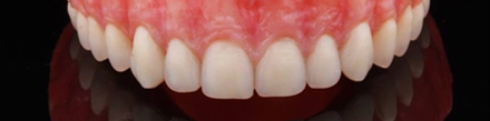 Prótesis Total. Una oportunidad de seguir sonriendo.