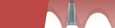 Implantes Dentales