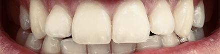 ¿Por qué los dientes cambian de color?